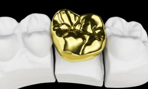 Gold Casting Alloy Full Gold Crown