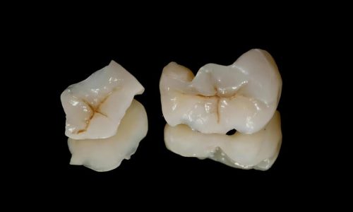 IPS. Emax Cad Esthetic Lithium Disilicate Inlays/Onlays