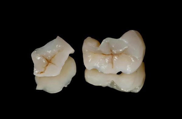 IPS. Emax Cad Esthetic Lithium Disilicate Inlays/Onlays
