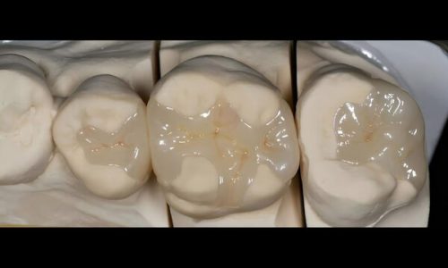 IPS. Emax Cad High Esthetic Partial Crown