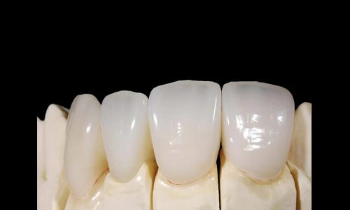 IPS. Emax Cad High Esthetic Full – Contour Crown