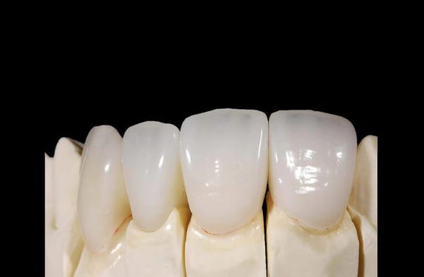 IPS. Emax Cad High Esthetic Full – Contour Crown