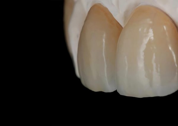 IPS. Emax Press High Esthetic Full Crown