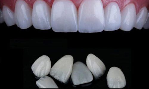 IPS. Emax Cad High Esthetic Laminate Veneer