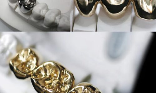 Gold Casting Alloy Full Gold Bridge
