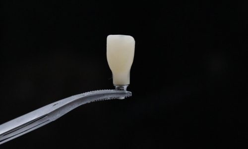 Implant Crowns & Bridges
