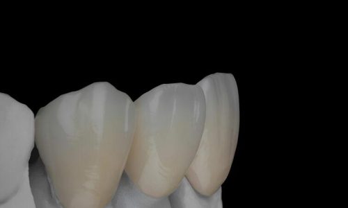 IPS. Emax Cad High Esthetic Full Three – Unit Anterior Bridge