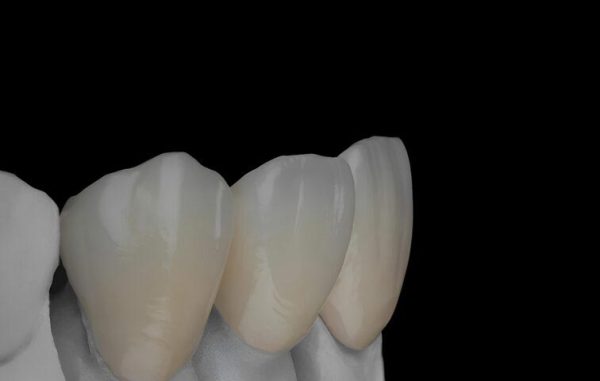 IPS. Emax Cad High Esthetic Full Three – Unit Anterior Bridge
