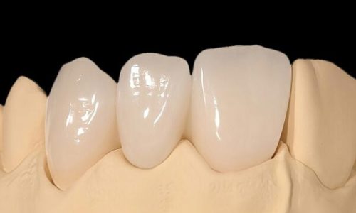 IPS. Emax Press Esthetic Three – Unit Bridge