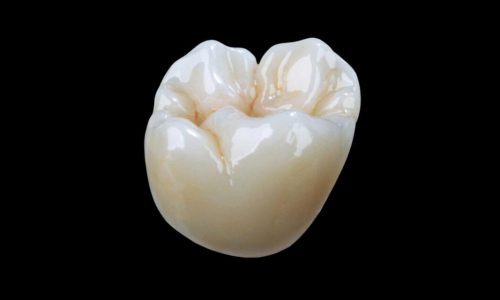 Bruxzir Esthetic Monolithic Full Crown