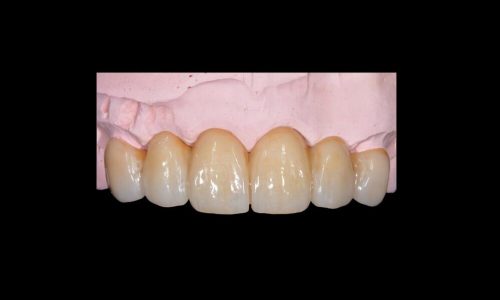Emax ZirCad Esthetics Monolithic Full Bridge