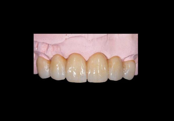 Emax ZirCad Esthetics Monolithic Full Bridge