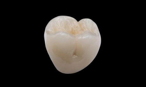 Porcelain Fused Metal Full Crown