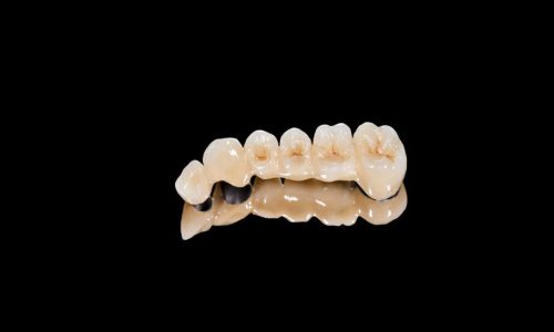 Porcelain Fused Metal Posterior Bidge
