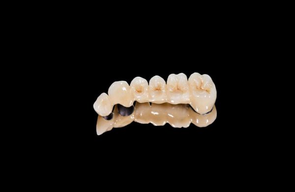 Porcelain Fused Metal Posterior Bidge