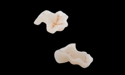 IPS. Emax Press Esthetic Lithium Disilicate Inlays/Onlays