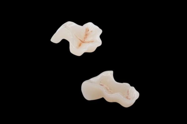 IPS. Emax Press Esthetic Lithium Disilicate Inlays/Onlays