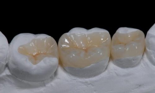 IPS. Emax Press High Esthetic Partial Crown