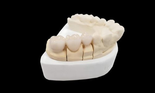 Porcelain Fused Zirconia Full Bridge