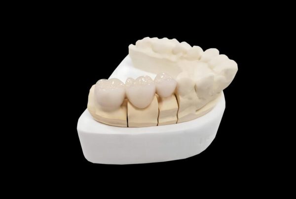 Porcelain Fused Zirconia Full Bridge