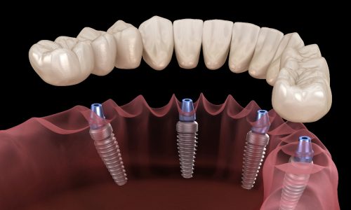 ALL-on-X dental implants