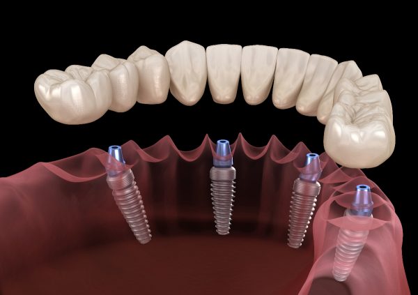 ALL-on-X dental implants