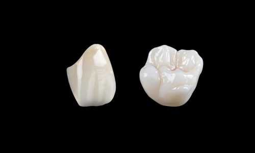 Porcelain Fused Zirconia Crown